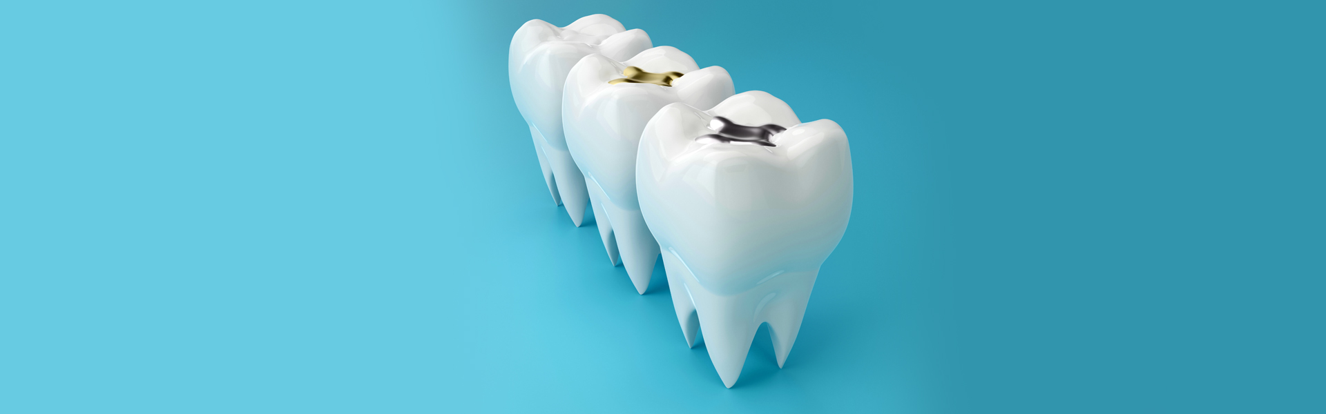 5 Advantages Tooth-Colored Fillings Have Over Silver Fillings