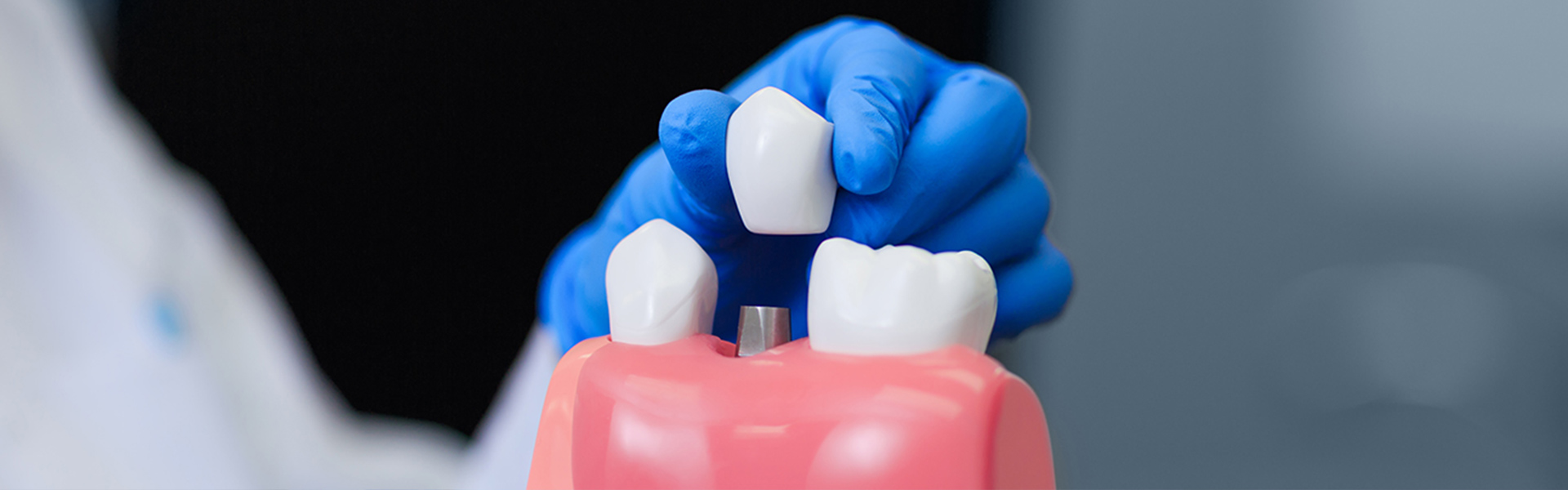 3 Big Benefits of Dental Implants