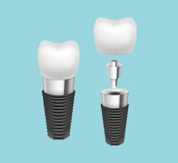 DENTAL IMPLANT FOR PERMANENT TEETH RESTORATION