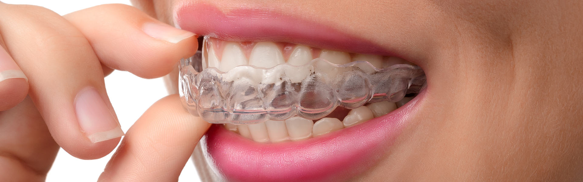 Everything You Should Know About ClearCorrect