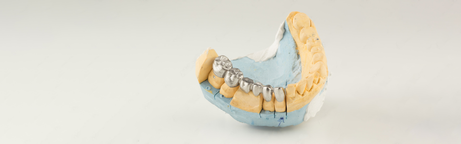 Why Consider the Five Health Benefits of Dental Bridges?