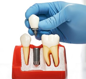 Why More Patients Choose Dental Implants Today
